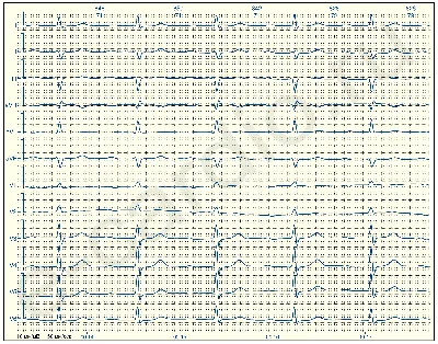 АВ блокада I степени - E-Cardio