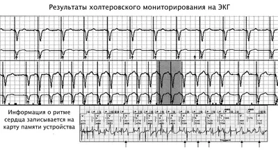 АЛГОРИТМЫ ЭКГ-ДИАГНОСТИКИ – 