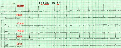 Анализ ЭКГ искусственным интеллектом: расшифровка данных и диагностика  нейронными сетями
