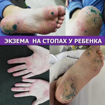 Результаты лечения Экземы на ногах у ребенка, МЦ Альтернатива, Киев