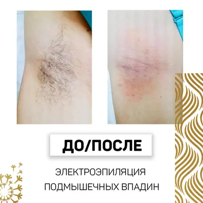 Электроэпиляция волос на груди у женщин в Москве — 915 косметологов, 333  отзыва, цены и рейтинг на Профи