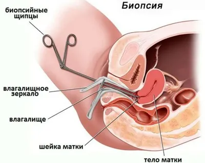 Эрозия шейки матки - причины, диагностика и лечение | Блог клиники БИНА