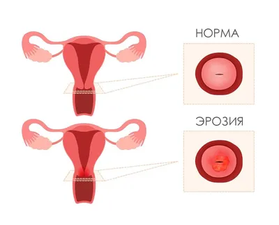Лечение эрозии шейки матки в клинике Семейный доктор в Москве