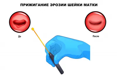 Какими способами можно вылечить эрозию шейки матки — блог медицинского  центра ОН Клиник