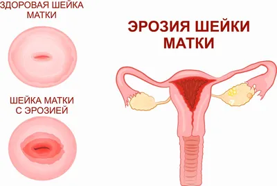 Эрозия шейки матки: диагностика и лечение в СПб, цена