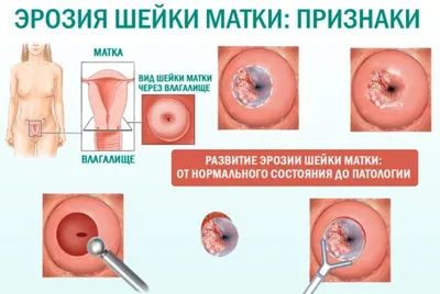 Лечение эрозии шейки матки, в т.ч радиоволновое в Челябинске