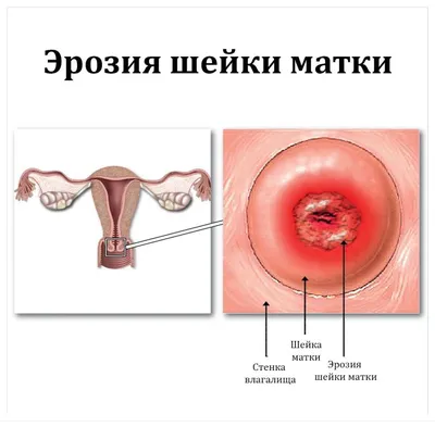 Эрозия шейки матки - причины, симптомы, диагностика и лечение