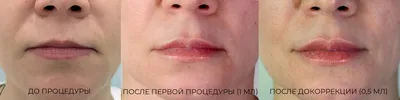 Увеличение губ гиалуроновой кислотой — Damas Medical Center