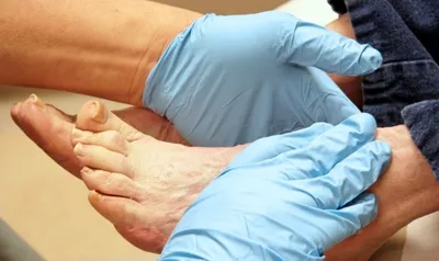 Гангрена нижних конечностей в пожилом возрасте, почему чернеют пальцы на  ногах у пожилого человека