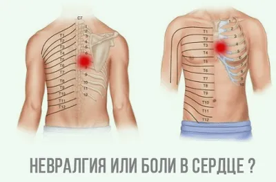 Как отличить боли в сердце от межреберной невралгии.