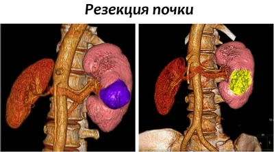 Рак почки - симптомы, фото, первые признаки, диагностика, лечение, стадии и  прогноз выживаемости