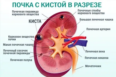 Опущение почки (нефроптоз): лечение