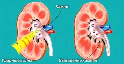 Литотрипсия - дробление и удаление камней в почках