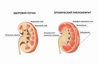 Пиелонефрит: симптомы, лечение, что это такое, диета, причины