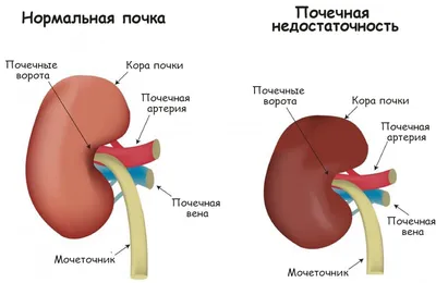 Лечение кисты почки в клинике «Наран»