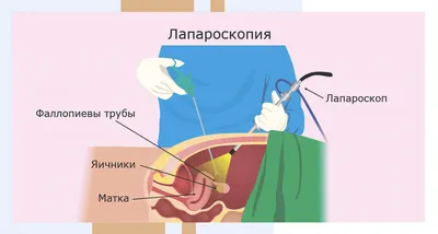 Спайки на яичниках: что это, симптомы, причины, диагностика и лечение