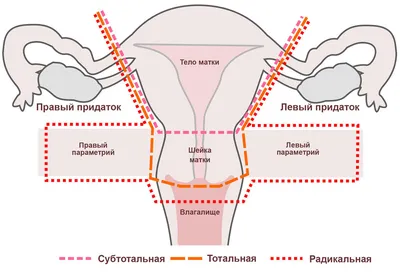 Удаление придатков матки (аднексэктомия) | Клиника «АльтраВита» | Дзен