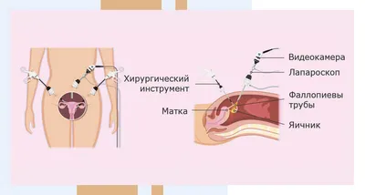 Операция Вертгейма: показания, как выполняется