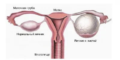 Сальпингоофорит хронический и острый: причины, симптомы, диагностика и  лечение в Москве