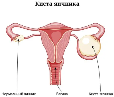 Киста яичника при беременности: опасна ли - Юнона