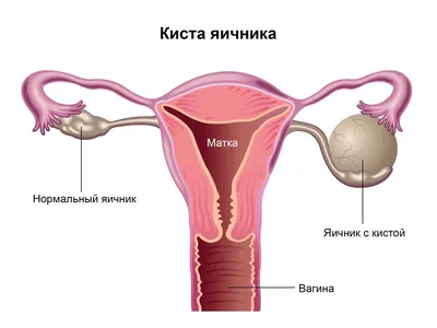 Киста яичника при беременности: опасна ли - Юнона