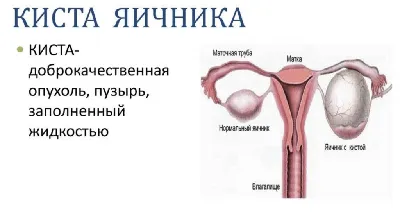 Киста яичника при беременности: опасна ли - Юнона