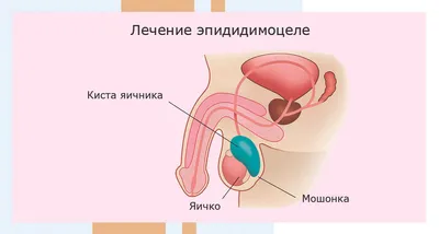 Лечение кисты придатка яичка (эпидидимоцеле) в Москве - цены в клинике  АльтраВита