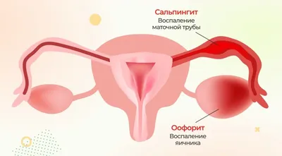 Оофорит — симптомы, диагностика и лечение воспаления яичников - Клиника  Здоровье 365 г. Екатеринбург