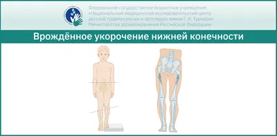 Артроз коленного сустава: причины, симптомы, виды, стадии, лечение без  операции в Москве