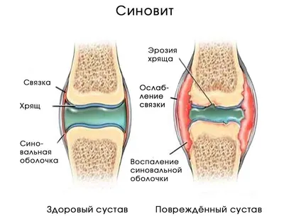 Лечение артрозов, артритов и синовитов - гиалуроновой кислотой | Отделение  платных медицинских услуг КДЦ №6