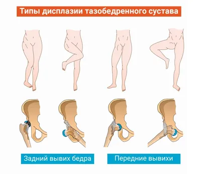 Дисплазия: что это такое, симптомы, признаки, лечение, виды