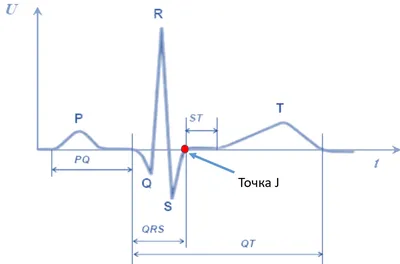 Точка J, оценка элевации сегмента ST | КлинКейсКвест