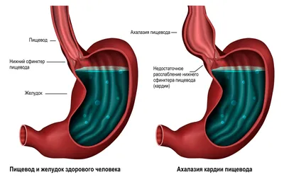 Нижний пищеводный (кардиальный) сфинктер