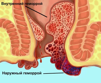 Эффективное лечение внутреннего геморроя - блог Виртус