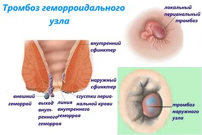 Лечение геморроя в медицинском центре «Я здоров», цены в Новосибирске