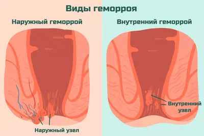 Геморрой у женщин - симптомы и лечение - диагностика геморроя