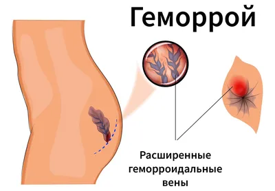 Лечение внутреннего геморроя — симптомы, причины и методы лечения болезни