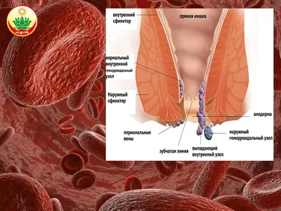 Эффективное лечение геморроя в медицинском центре | Клиника Частная  врачебная практика в Челябинске