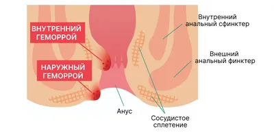 Геморрой у женщин: причины, симптомы, признаки, что делать, как избавиться,  лечение