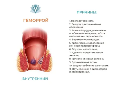 Наружный геморрой: симптомы и методы лечения