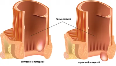 Геморрой у мужчин и женщин: симптомы, суть проблемы, методы лечения и  удаления