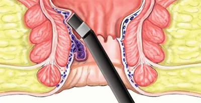 Лечение геморроя в Киеве, цена операции по удалению геморроидальных узлов |  Medcity