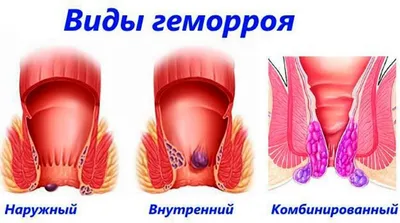 Геморрой: симптомы, причины, наружный и внутренний, стоимость лечения и  операции
