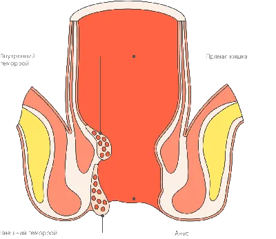 Лечение геморроя в Москве: симптомы, причины, виды, профилактика и методы  воздействия