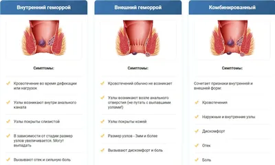 Лечение геморроя со свищем в медицинском центре «Я здоров», цены в  Новосибирске