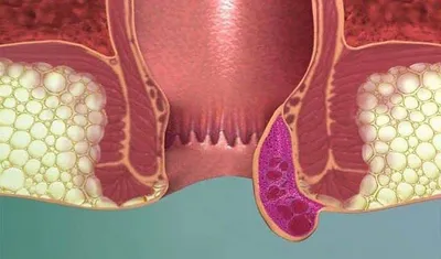 Причины возникновения геморроя, способы лечения гемороя