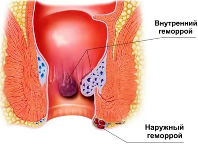 ТОП-14 препаратов от геморроя - рейтинг хороших средств 2021