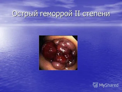 Геморрой: острый и хронический. Симптомы геморроя. Лечение геморроя в  Санкт-Петербурге