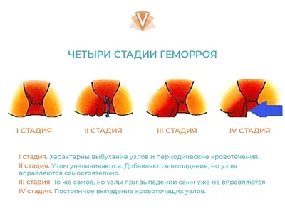 Острый геморрой: лечение, причины, симптомы, диагностика и профилактика