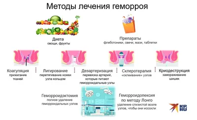 Геморрой: лечение, симптомы, причины, виды профилактика, последствия и  диагностика заболевания